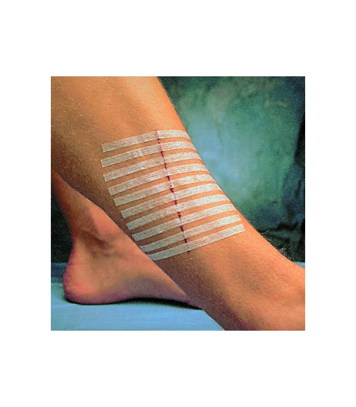 steri-strip bandes sont des sutures adhésives de premiers secours utilisées  en cas de plaie ouverte